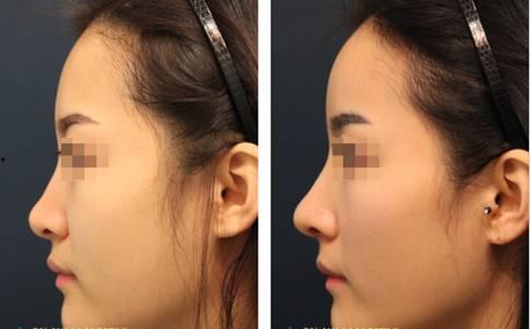 明星玻尿酸隆鼻